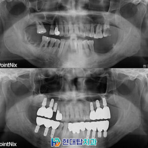 울산동구임플란트