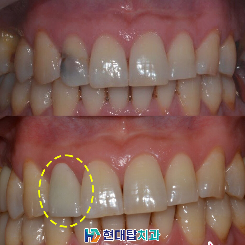 울산동구임플란트 