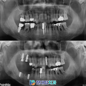 울산동구임플란트