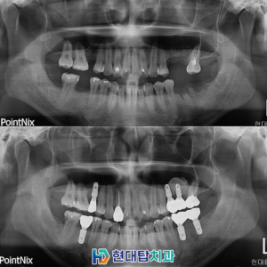 울산동구임플란트