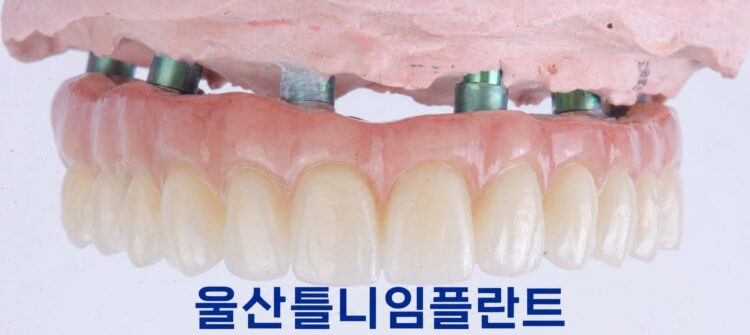 치아 상실 후 울산틀니임플란트를 상담하는 과정